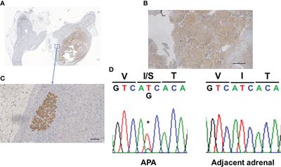 Primary aldosteronism caused by a pI157S somatic KCNJ5 mutation in a black adolescent female with aldosterone-producing adenoma